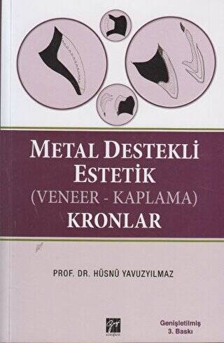 Metal Destekli Estetik Veneer-KaplamaKronlar - 1